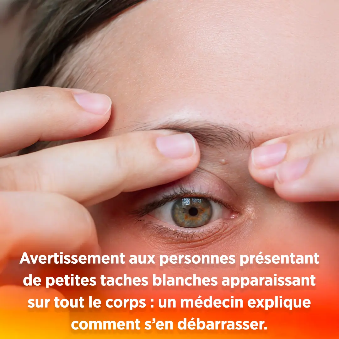 Avertissement aux personnes presentant de petites taches blanches apparaissant sur tout le corps un medecin explique comment sen debarrasser.jpg (1)
