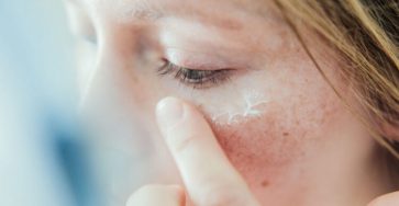 Comment soigner eczema naturel 750x410