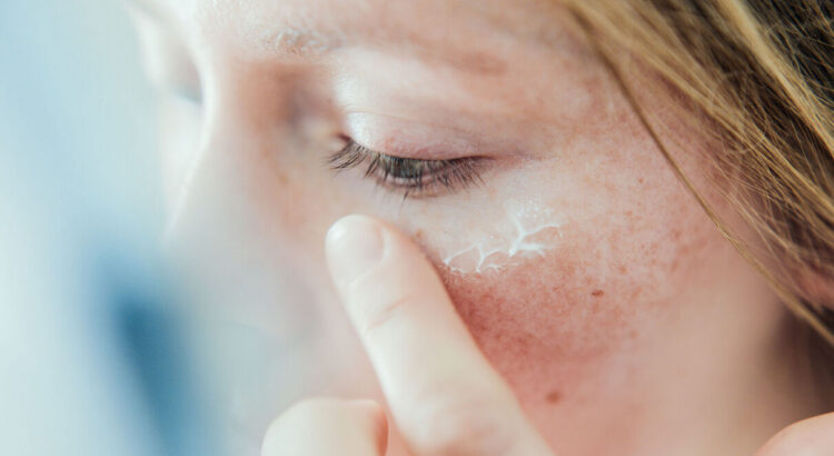Comment soigner eczema naturel 750x410