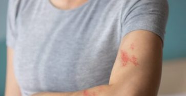 Woman,With,Shingles,On,The,Skin,She,Feels,Very,Painful