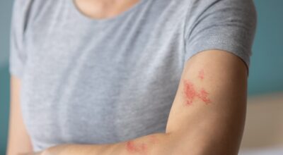 Woman,With,Shingles,On,The,Skin,She,Feels,Very,Painful