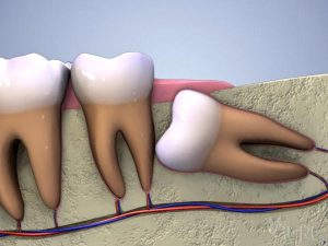 Dents de sagesse